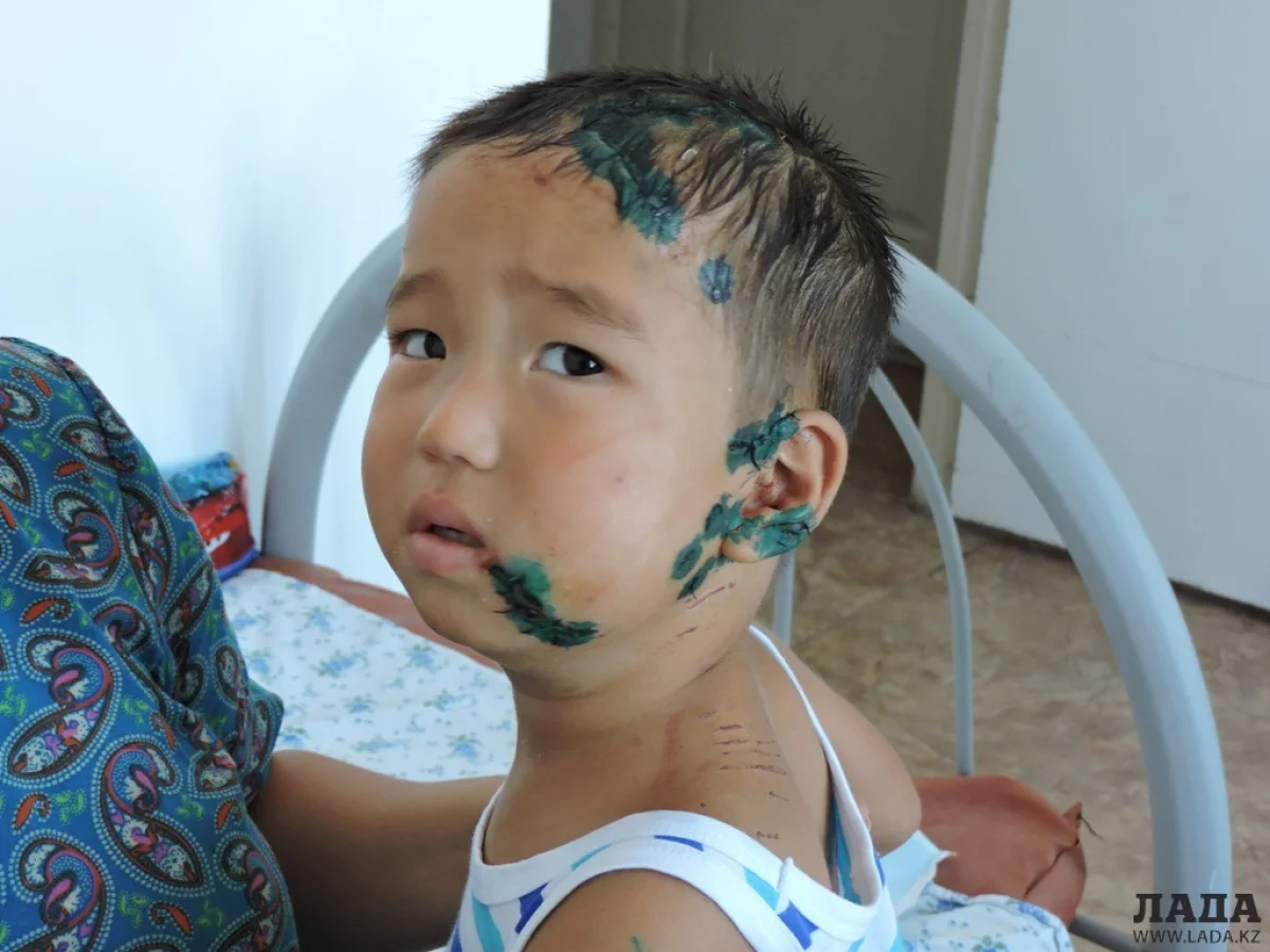 Малыш, пострадавший от укуса собаки. Фото автора