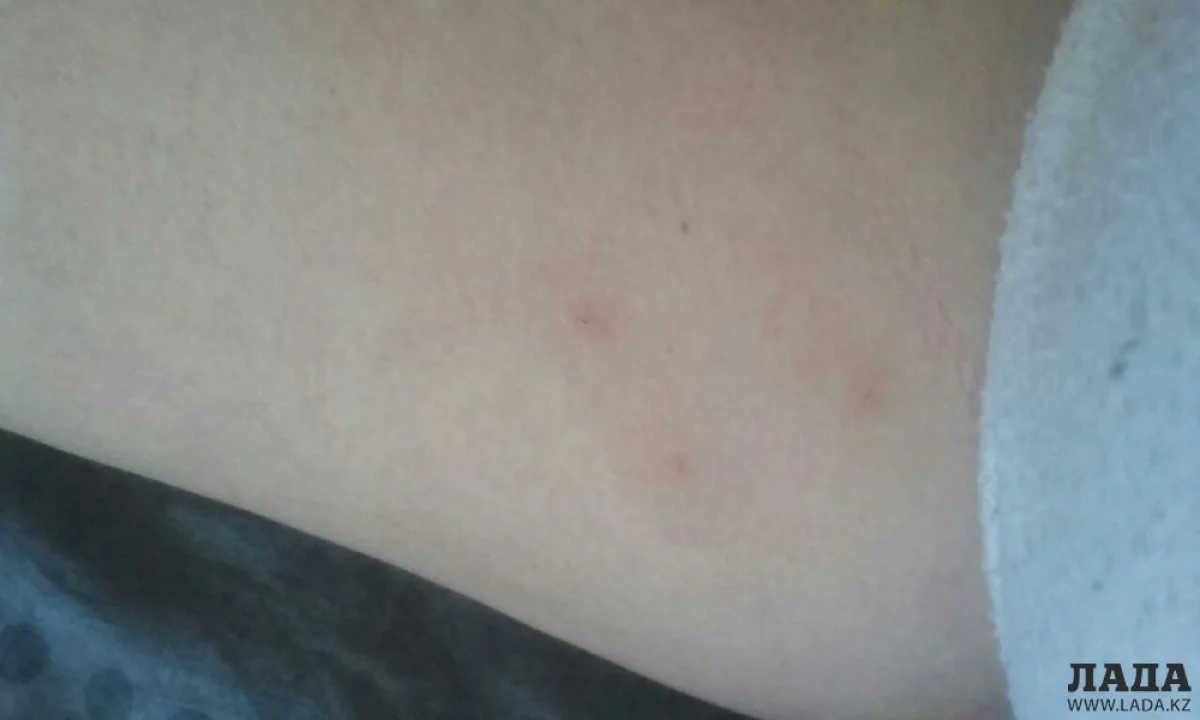 Снимок укусов через неделю после выписки