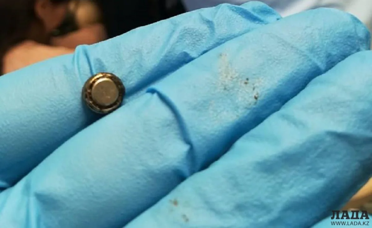 Изъятая батарейка. Фото предоставлено клиникой