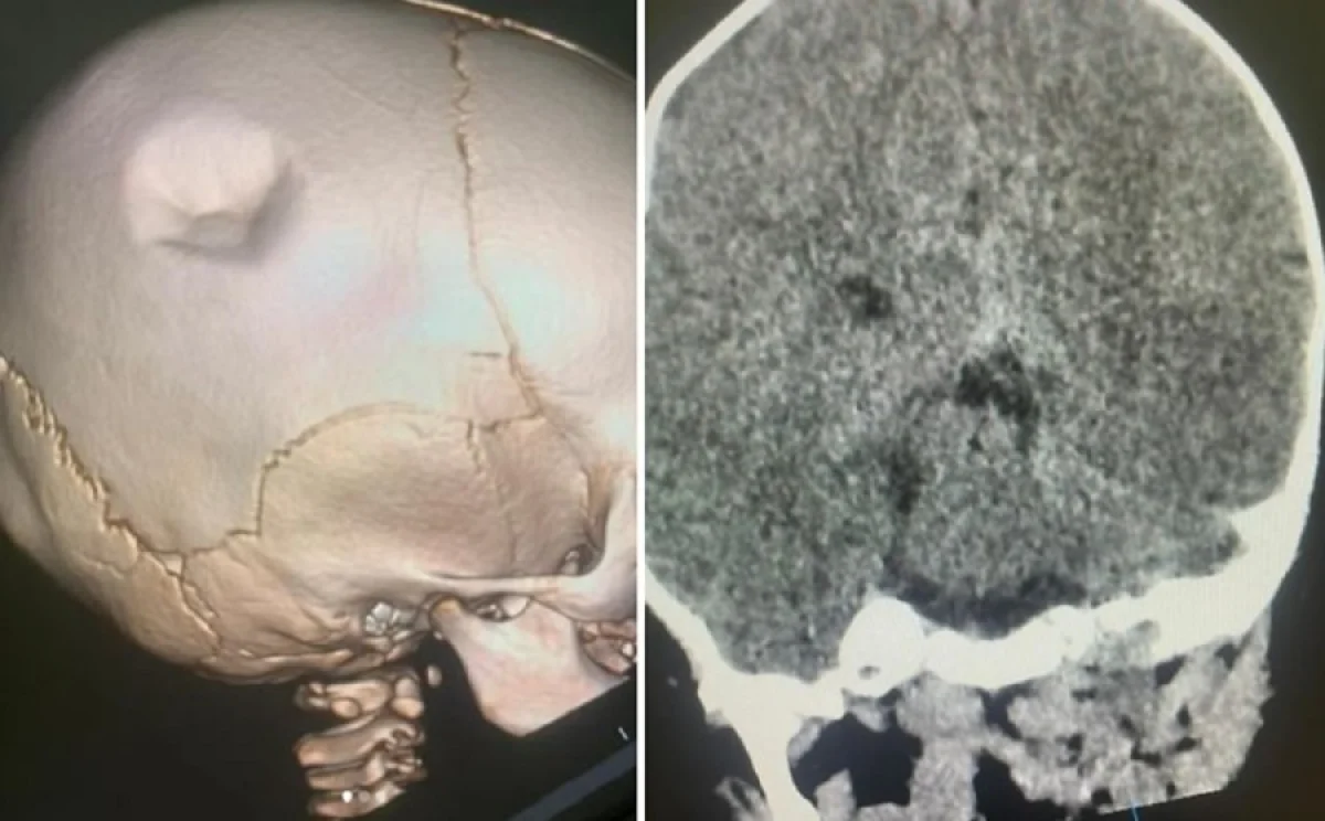 Результаты КТ пострадавшего ребёнка. Фото Ербола Кенжевалова