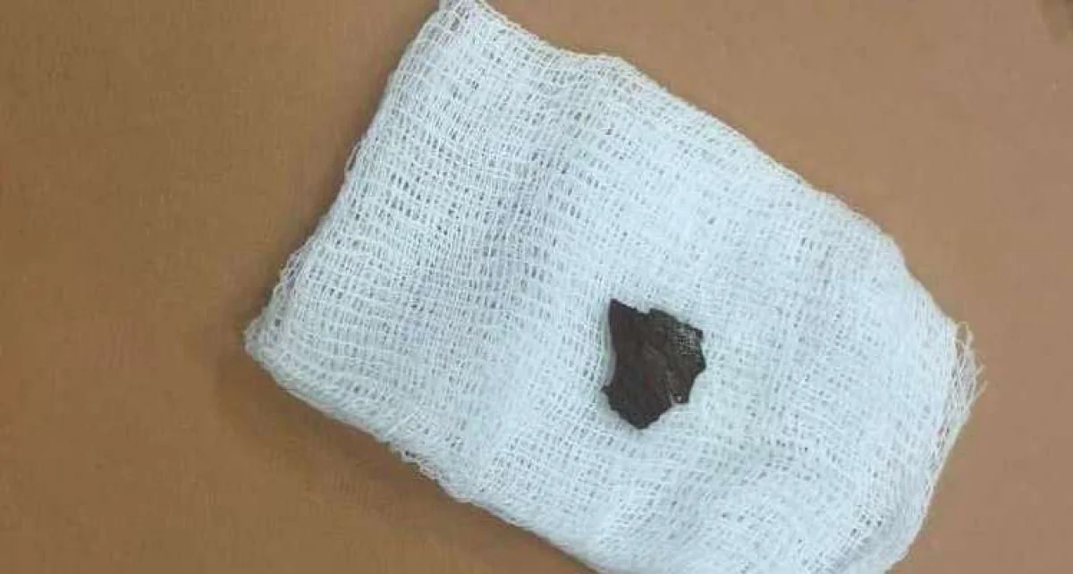 Извлеченное инороное тело. Фото предоставлено пресс-службой управления здравоохранения