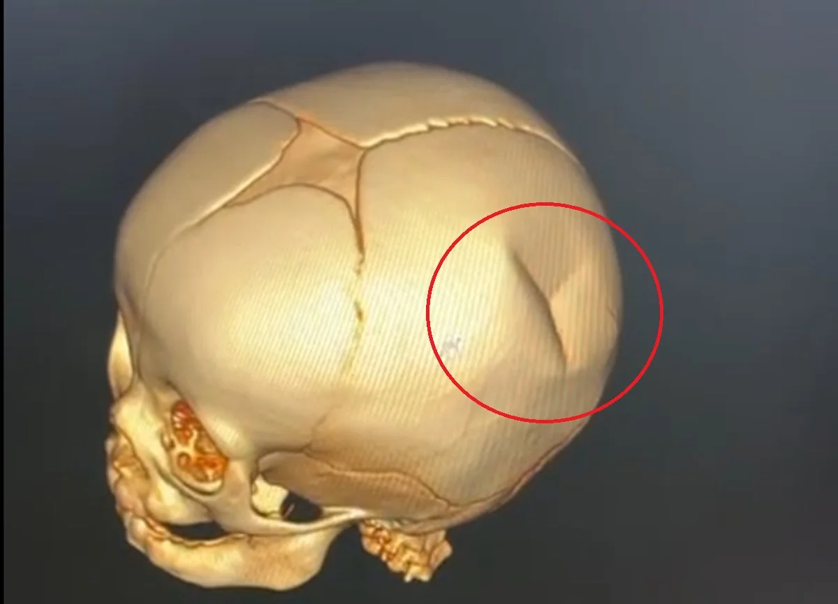 Снимок МРТ костей черепа восьмимесячного малыша