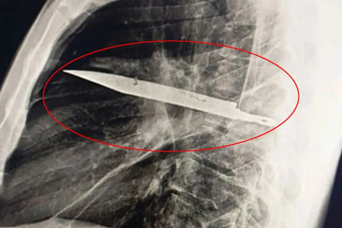 Фото: Journal of Surgical Case Reports