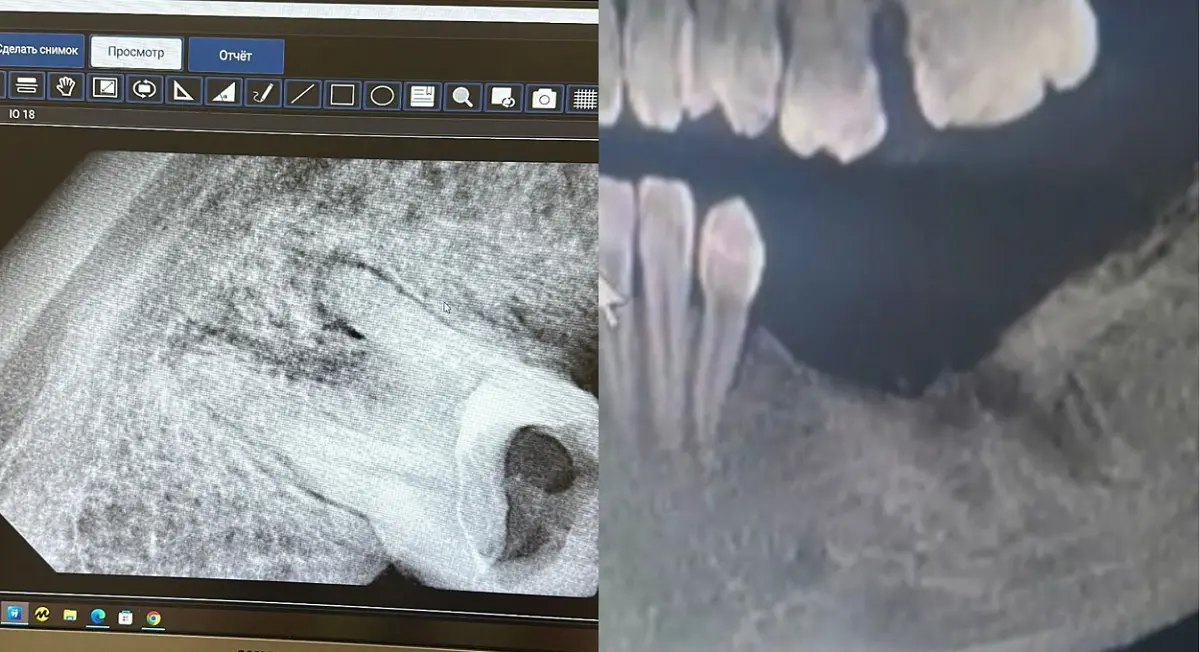 Снимки рентгена. Фото предоставил Батырбек Жанаев