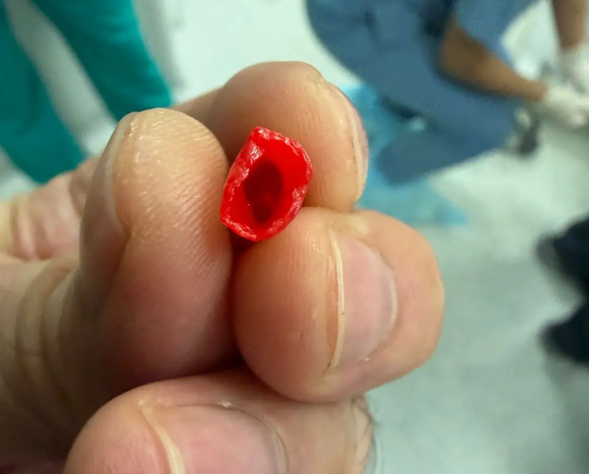 В Актау из бронхов ребенка извлекли колпачок от ручки