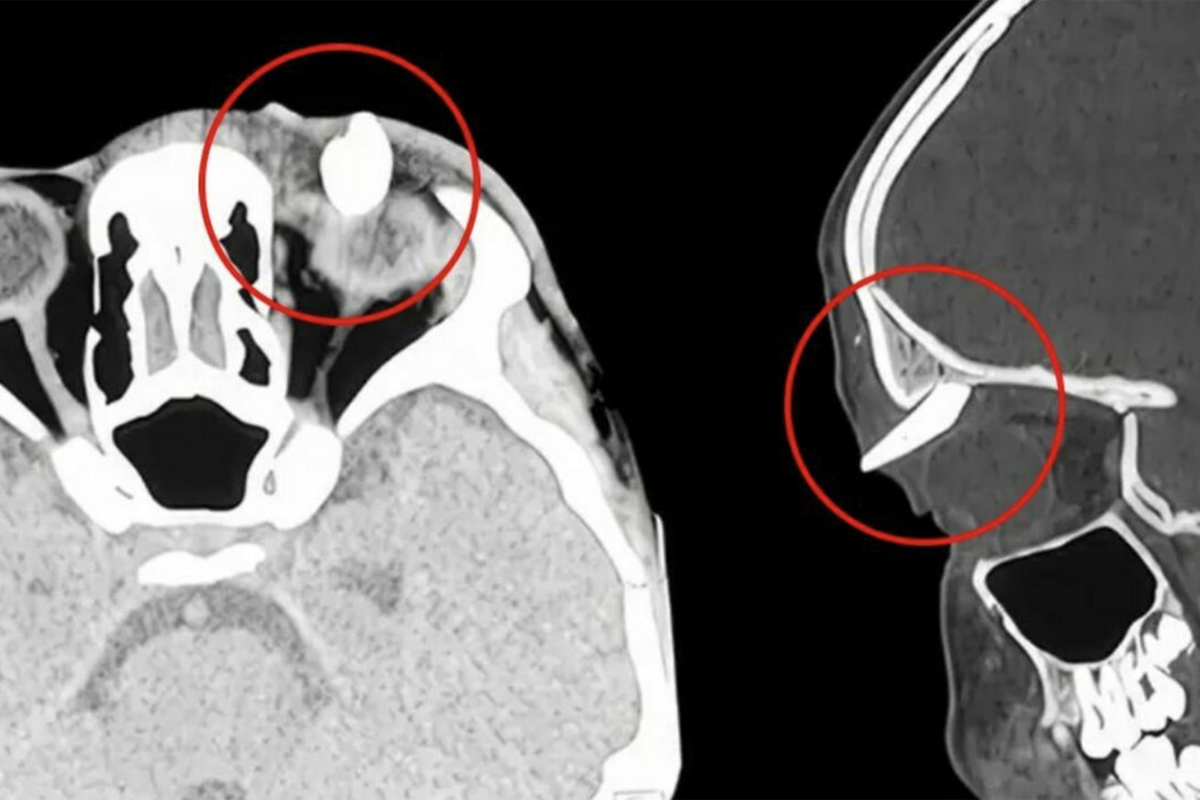 Фото: American Academy of Ophtalmology