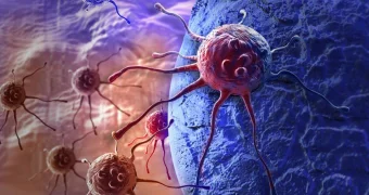 Какой вид рака самый распространенный в Казахстане, рассказала главный онколог Минздрава