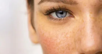 Почему веснушки являлись признаком греха, а их обладателей считали связанными с нечистой силой