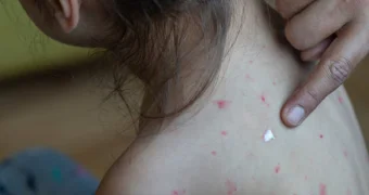 С начала года в Мангистау зарегистрировано 44 случая кори