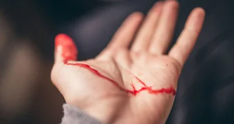 Врач рассказал, почему нельзя мазать йодом открытые раны