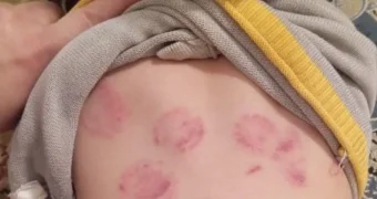 «Живого места не осталось»: в Казахстане ребенка покусали дети в ясельной группе