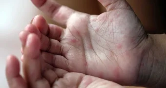 «Температура 40 и язвы»: вирус Коксаки распространяется среди детей в Казахстане