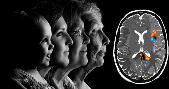 Названы 3 профессии с самым высоким риском деменции