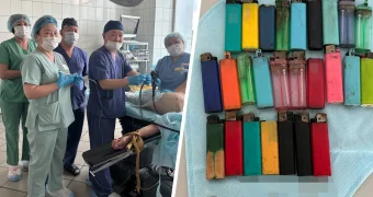 Врачи спасли мужчину, который проглотил 27 зажигалок