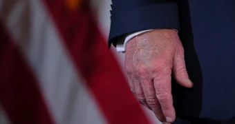 Что скрывает под гримом Трамп: в Белом доме рассказали о синяках на теле