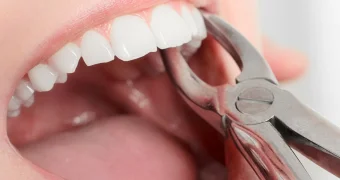 Стоматолог рассказал, какой зуб нельзя спасти