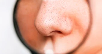 «Треугольник смерти» на лице: чем опасно выдавливание прыщей в этой зоне