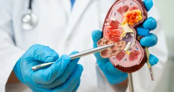 Названы продукты, защищающие от образования камней в почках