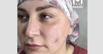 Женщины с Кавказа массово делают операции ради ямочек на щеках