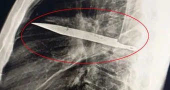 Мужчина 8 лет прожил с ножом в грудной клетке
