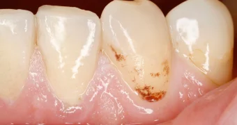 Врач объяснила, может ли передаваться кариес через поцелуи