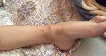 На нашествие блох жалуются жители 14 микрорайона Актау