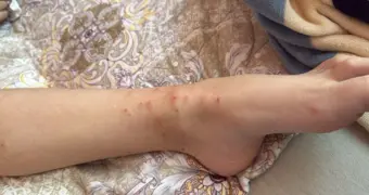 Жители 14 микрорайона Актау продолжают бороться с нашествием блох своими силами