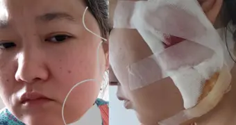 Прокололи щеку: жительница Актау получила осложнения после удаления зуба