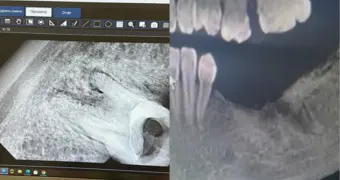 Удалила зуб и попала в больницу: стоматолог прокомментировал инцидент с жительницей Актау