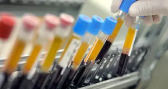 «Вне системы»: врачи столкнулись с редким типом крови, не поддающимся классификации