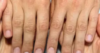 Склонность к алкоголизму можно определить по длине пальцев