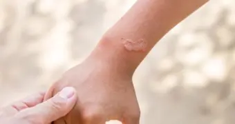 Жителей Актау предупреждают об опасности сезонного кожного заболевания