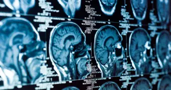 Болезнь Альцгеймера можно выявить задолго до симптомов — найден новый маркер