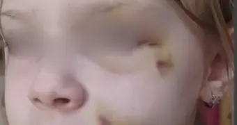 Ушибы и гематомы: школьницу придавило железной скамейкой в Актау