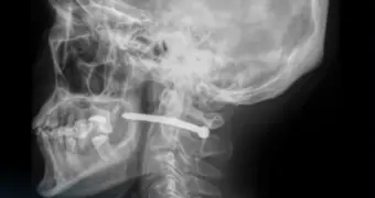 Необычный несчастный случай: казахстанец прострелил себе шею гвоздём