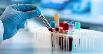 В крови переболевших COVID-19 нашли следы «невидимого боя»: что обнаружили ученые