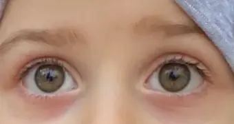 Синяки под глазами у детей: обычная усталость или тревожный сигнал?