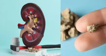 Названы продукты, из-за которых в почках появляются камни