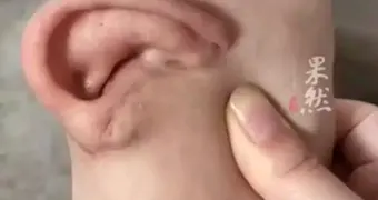 Ухо на ноге: китаянка пять месяцев носила орган на стопе ради восстановления