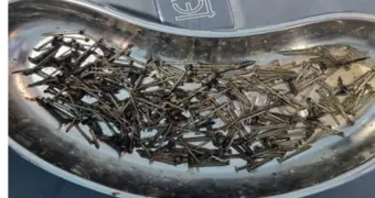 В Узбекистане мужчина из-за стресса проглотил десятки гвоздей и саморезов