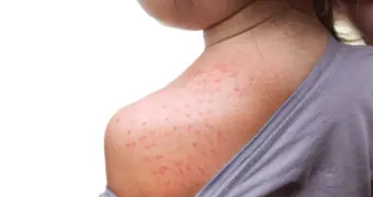 Сколько случаев кори зарегистрировали в Мангистау с начала 2026 года