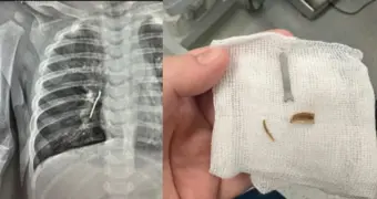 В Актау из лёгких годовалого ребёнка извлекли кожуру от семечки и металлический предмет