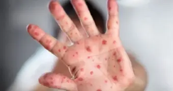 Ситуация по кори в Мангистау остается нестабильной – санэпидемиологи