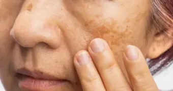 Названо средство, которое поможет убрать пигментацию и замедлить старение кожи