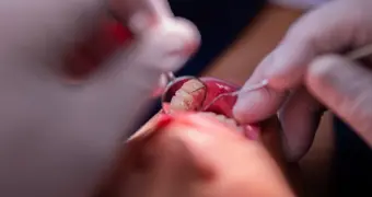 Названы самые бесполезные процедуры в кабинете стоматолога