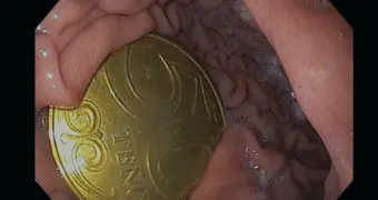 В Актау врачи извлекли из желудка ребёнка монету