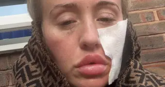 Из-за редкой болезни женщина не может выходить из дома, когда на улице ветер или холодно