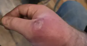 Рука мужчины превратилась в «боксерскую перчатку» после укуса паука