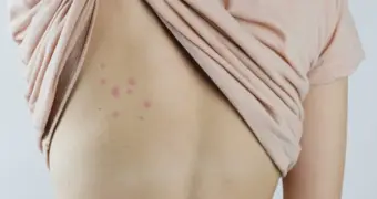 Случайное открытие ученых может изменить борьбу с клопами
