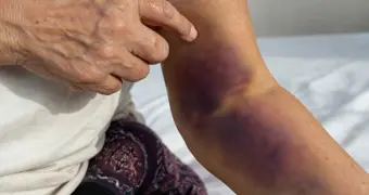 Одно лечат, другое калечат: после внутривенных инъекций у жительницы Актау не работает рука